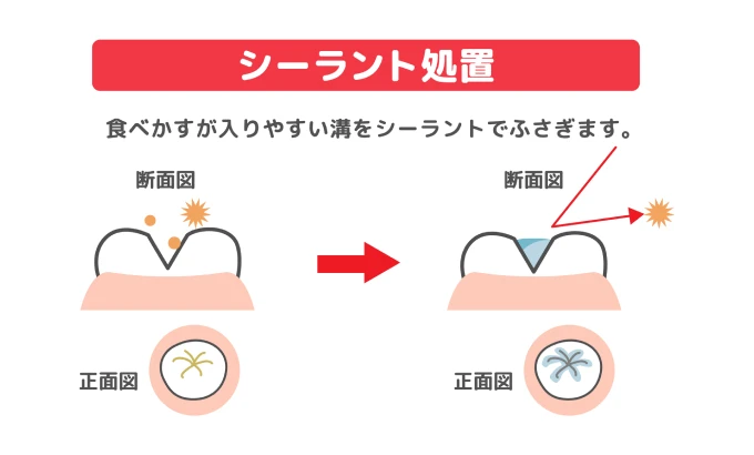 シーラント